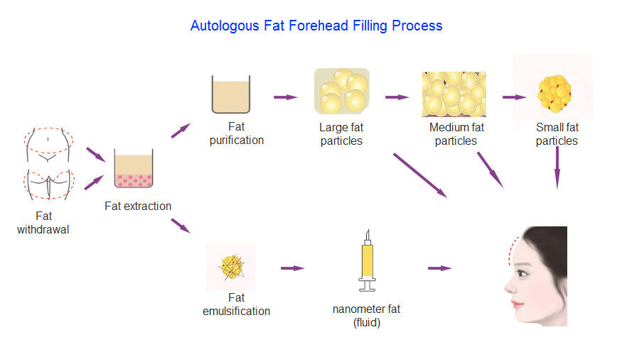 forehead fat filling process