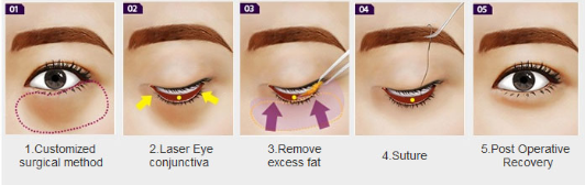 eyebag removal