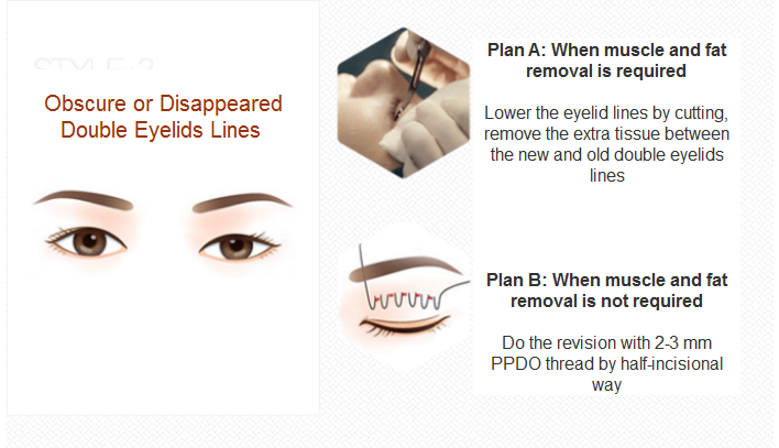 eyelid revision