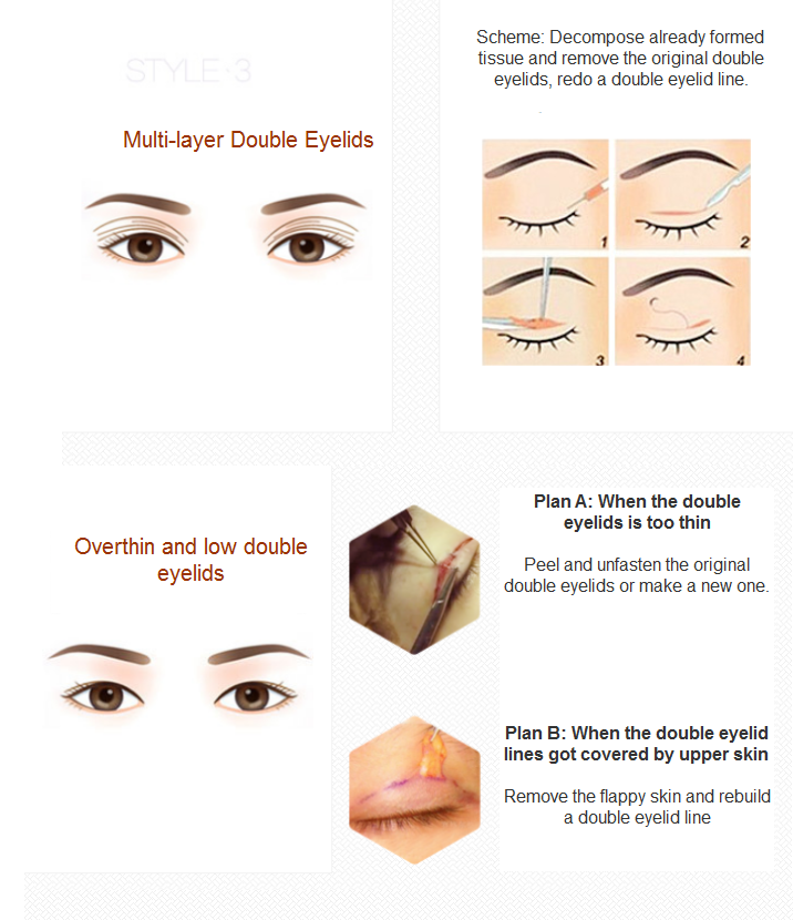 eyelid revision