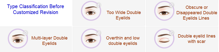 revisional double eyelid surgery