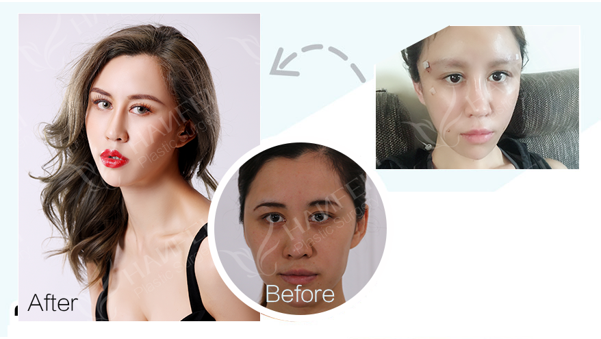 facial anti-aging
