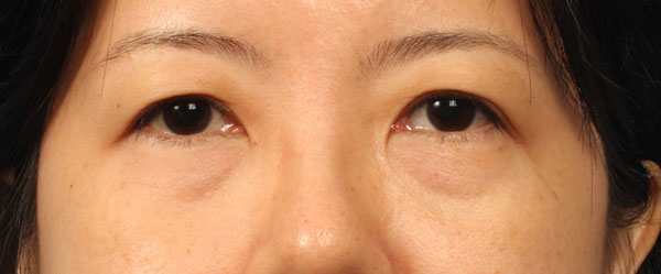 Eye bag or eye-pouch is the dropsy dark part under the lower eyelid