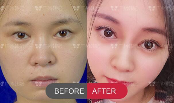 double eyelids surgery and autologous fat face filling