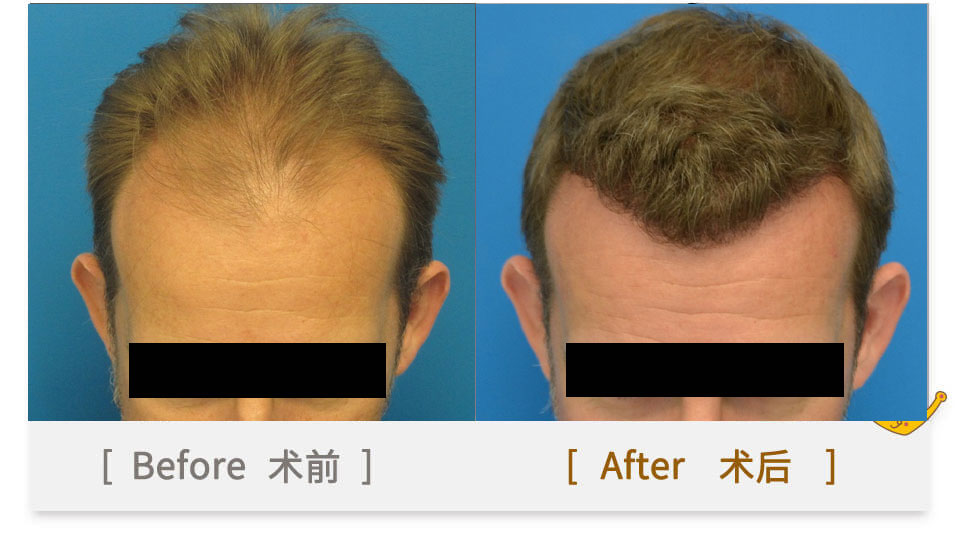 hair transplant in guangzhou china for girls