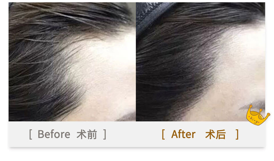 hair tranplant effect before and after