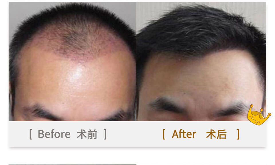 hanfei hair plant on men's head top before & after