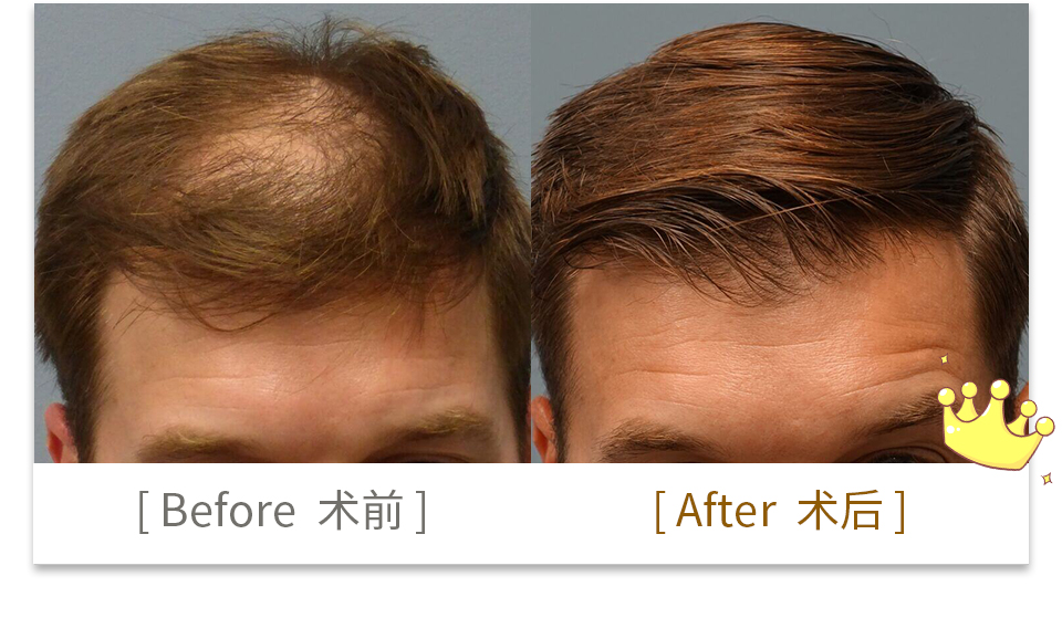 hair transplant china