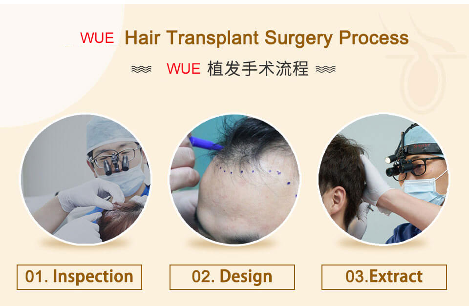 WUE hair transplant process