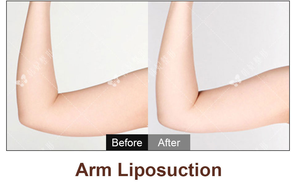 arms liposuction