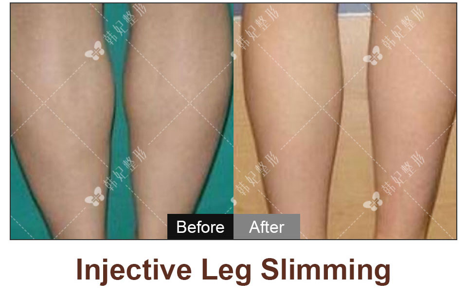 legs liposuction