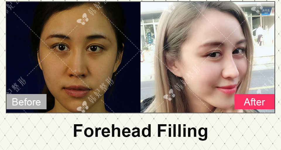 forehead filling