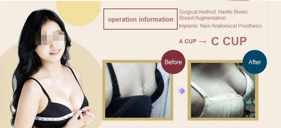 implants breast augmentation before & after photos