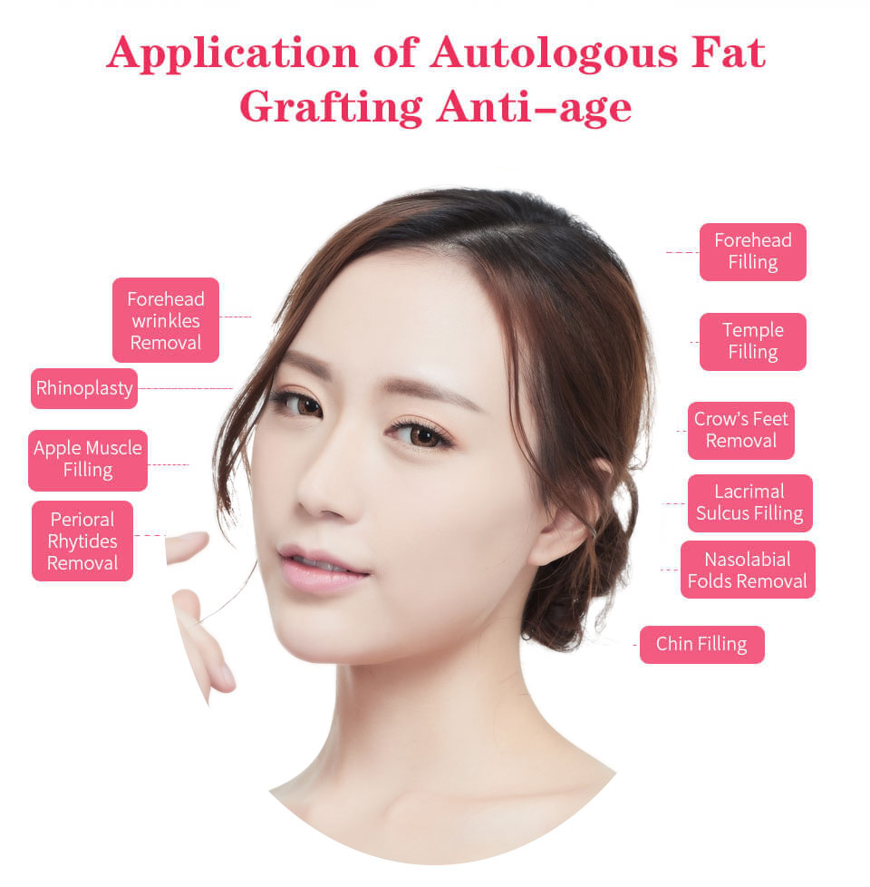 which parts on face self fat can fill
